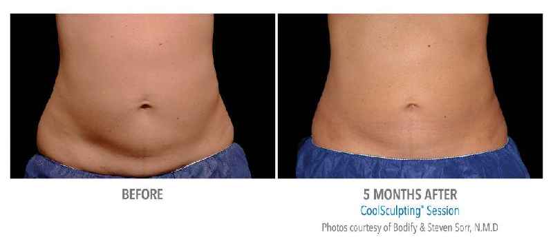 Is CoolSculpting worth it for love handles