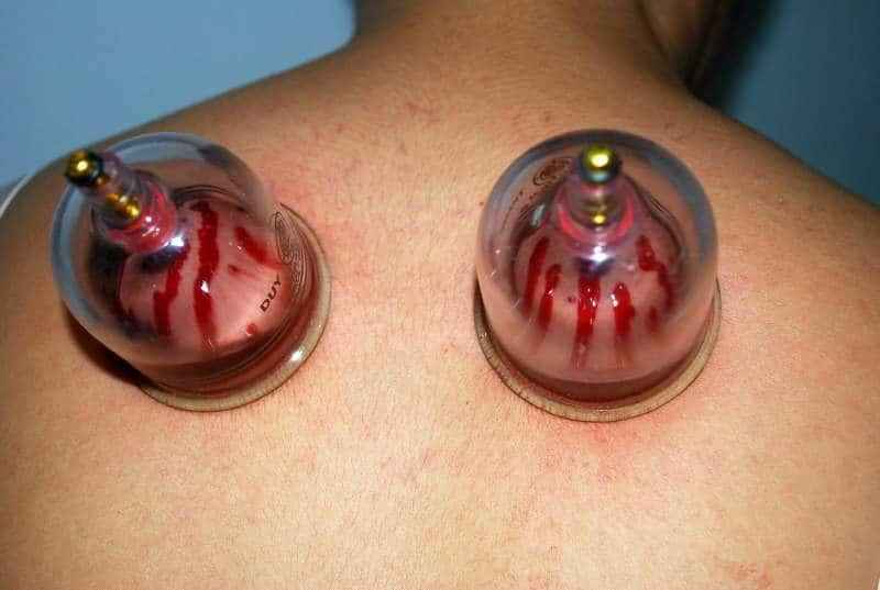 Is cupping painful