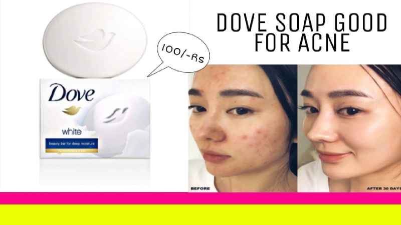 Is Dove soap good for acne