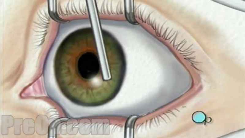 Is eyelid surgery safe