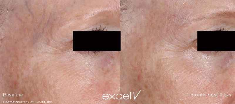Is Fraxel laser painful