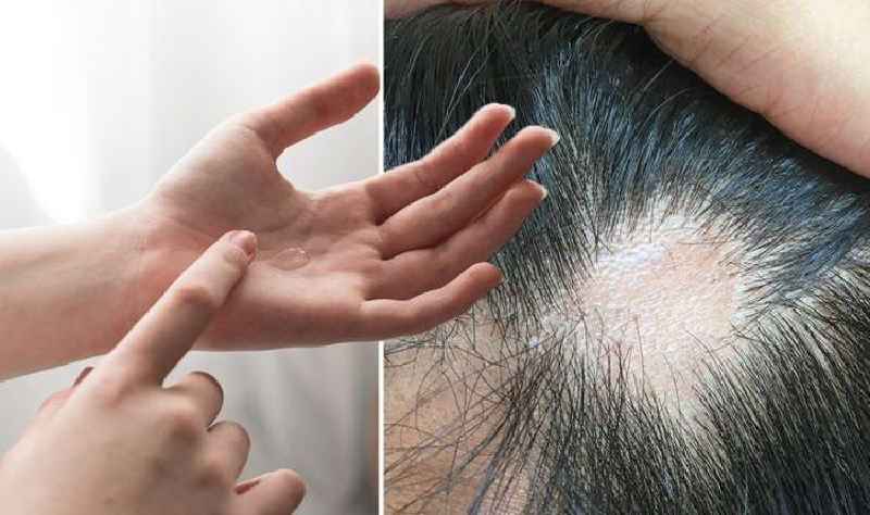 Is hair loss common with Topamax