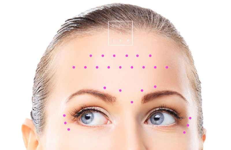 Is hyaluronic acid better than Botox