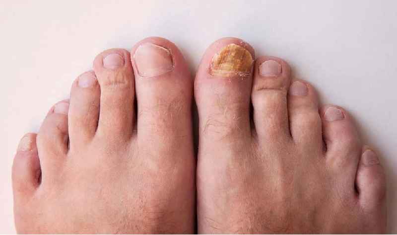 Is hydrogen peroxide good for toenail fungus