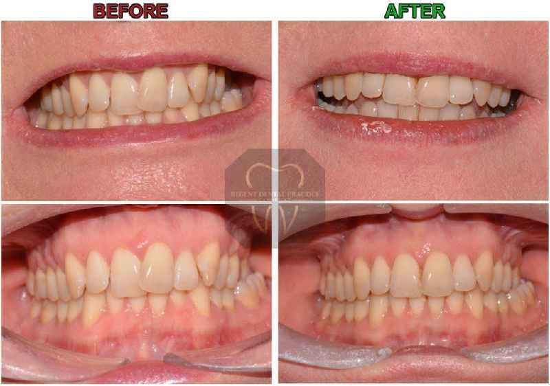 Is Invisalign as effective as braces