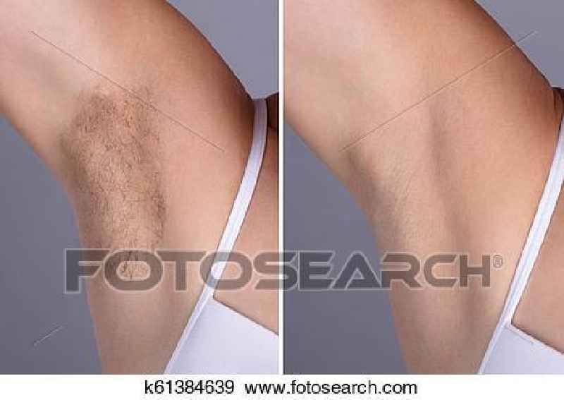 Is it better to wax or shave before IPL
