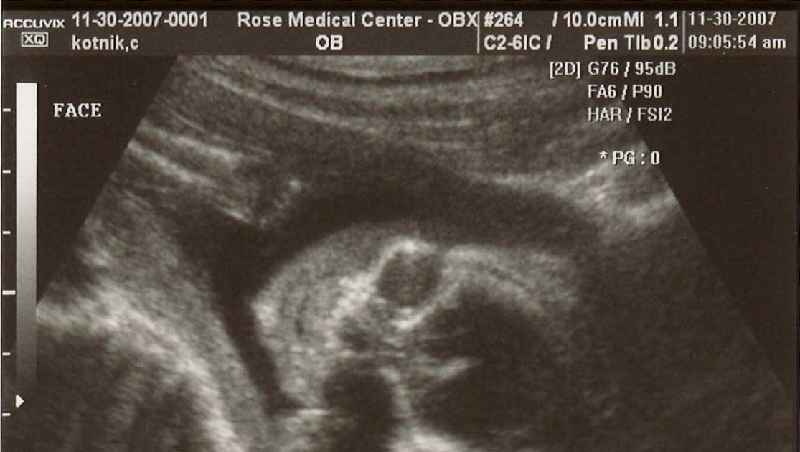 Is it normal for baby to not move during ultrasound