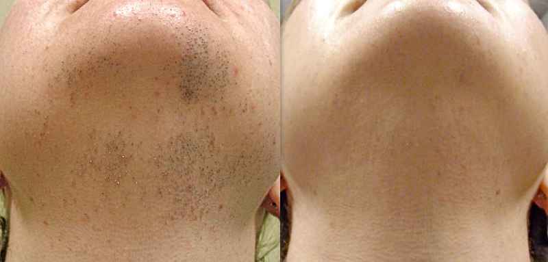 Is it OK to wax after laser hair removal