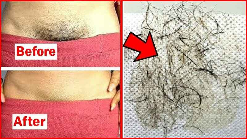 Is it possible to remove pubic hair permanently