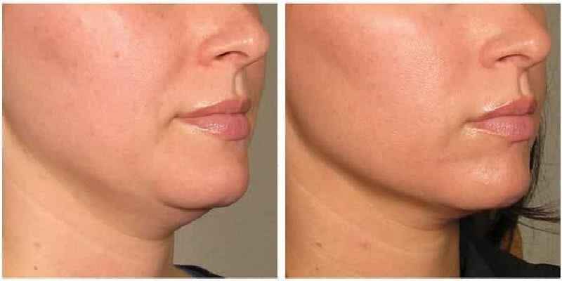 Is it possible to tighten loose skin naturally