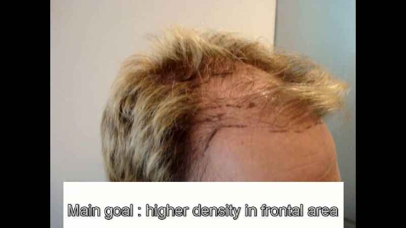Is kérastase good for hair loss