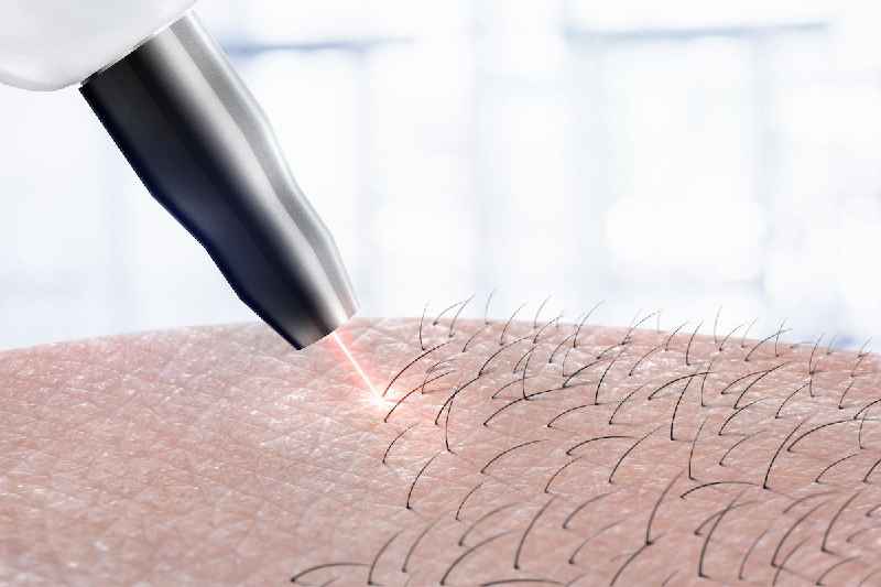 Is laser hair removal actually permanent