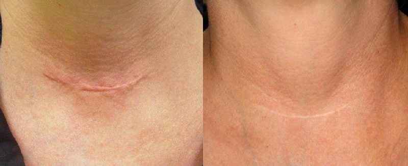 Is laser treatment for stretch marks painful