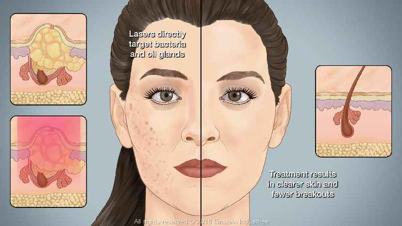 Is laser treatment good for pimples