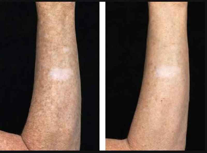 Is laser treatment painful