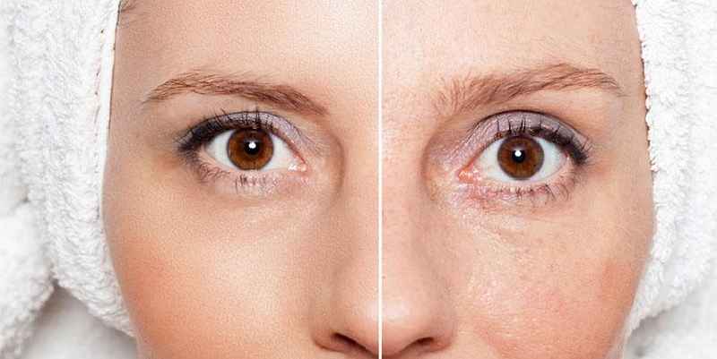 Is Microneedling good for wrinkles