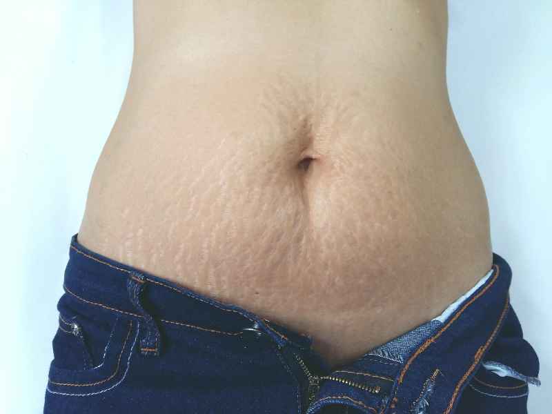 Is microneedling or laser better for stretch marks