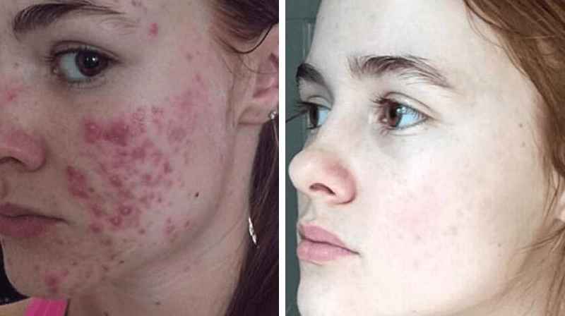 Is niacinamide good for acne