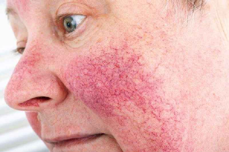 Is PHA good for rosacea