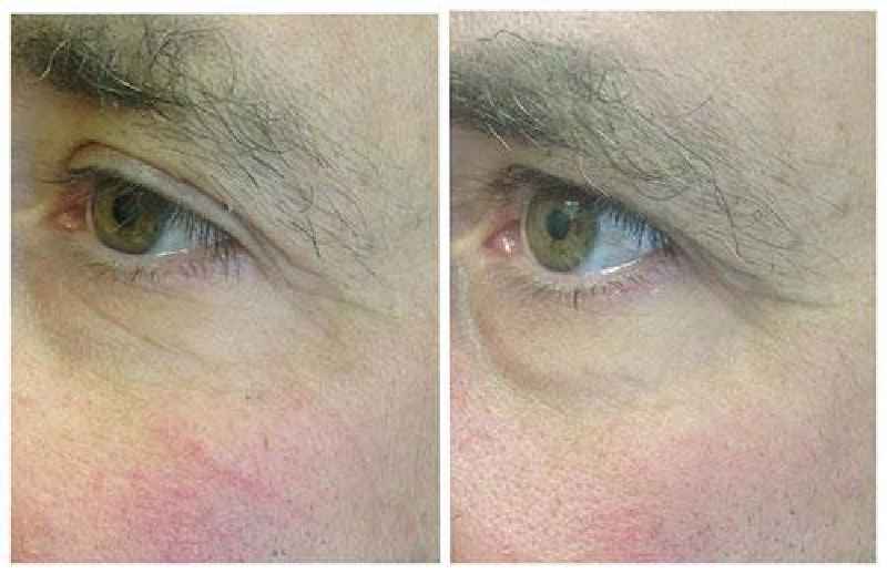 Is PRP good for under eye wrinkles