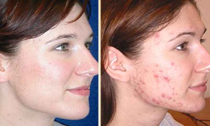 Is salicylic acid good for acne