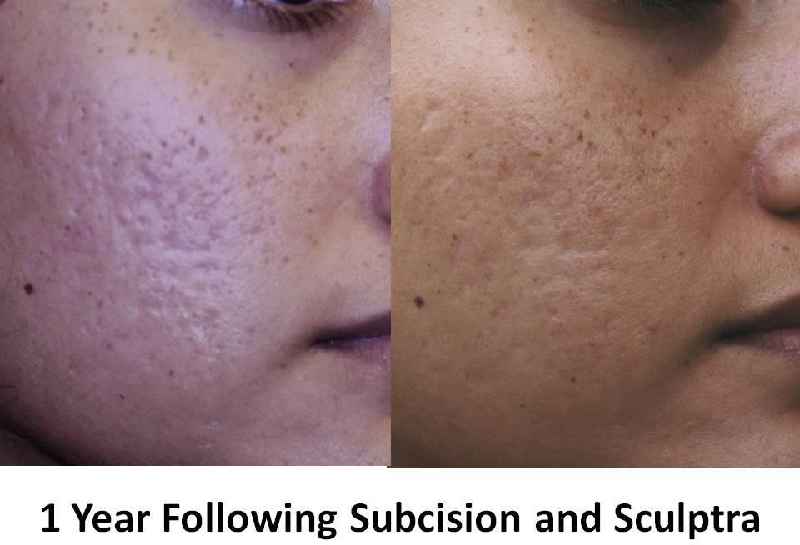 Is sculptra good for acne scars