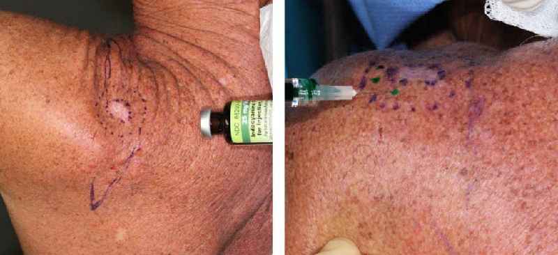 Is skin cancer easily treatable