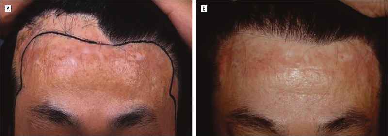 Is skin transplant possible
