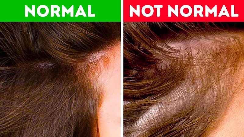 Is teenage hair loss normal