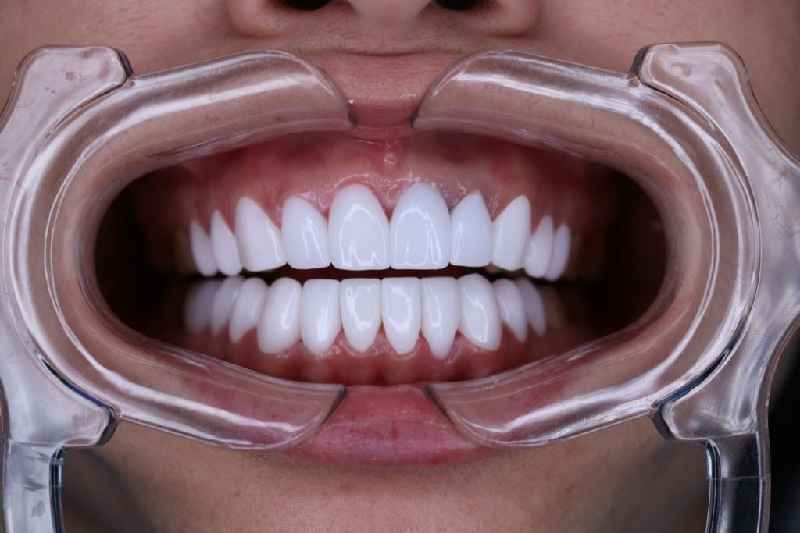 Is Teeth Whitening a cosmetic procedure