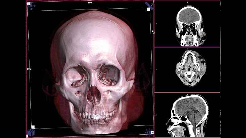 Is the ethmoid bone a facial bone