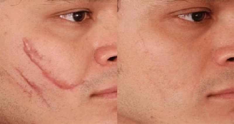 Is there a plastic surgery to remove acne scars