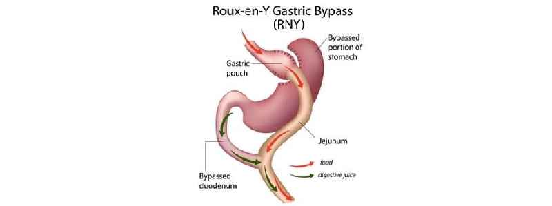 Is there a weight limit for gastric sleeve