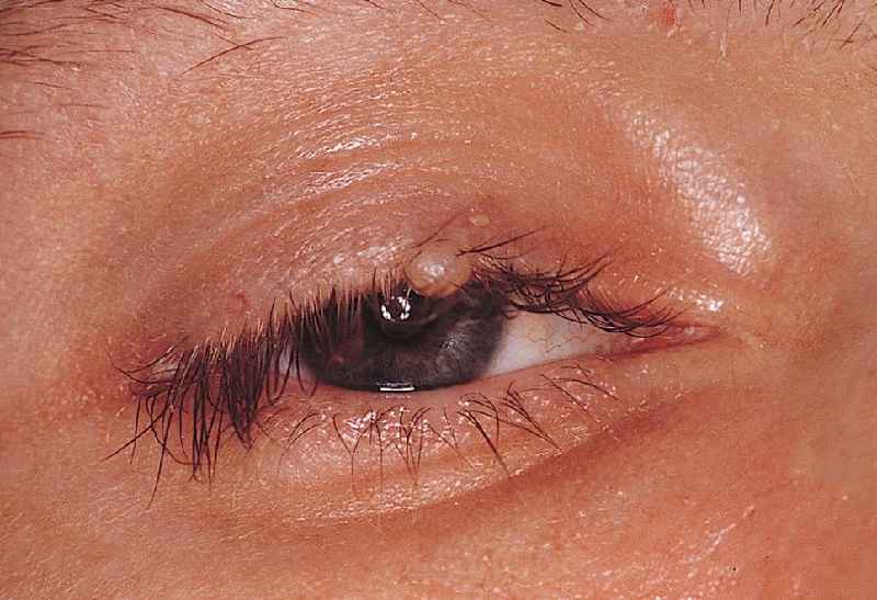 Is there an alternative to eyelid surgery