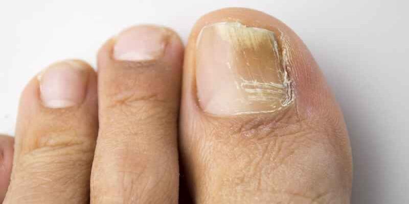 Is toenail fungus common in diabetics