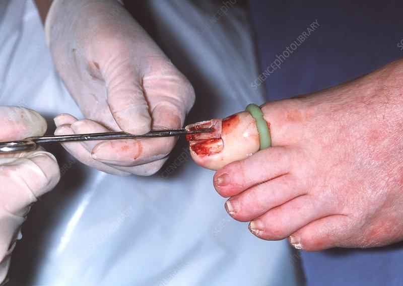 Is toenail removal considered surgery