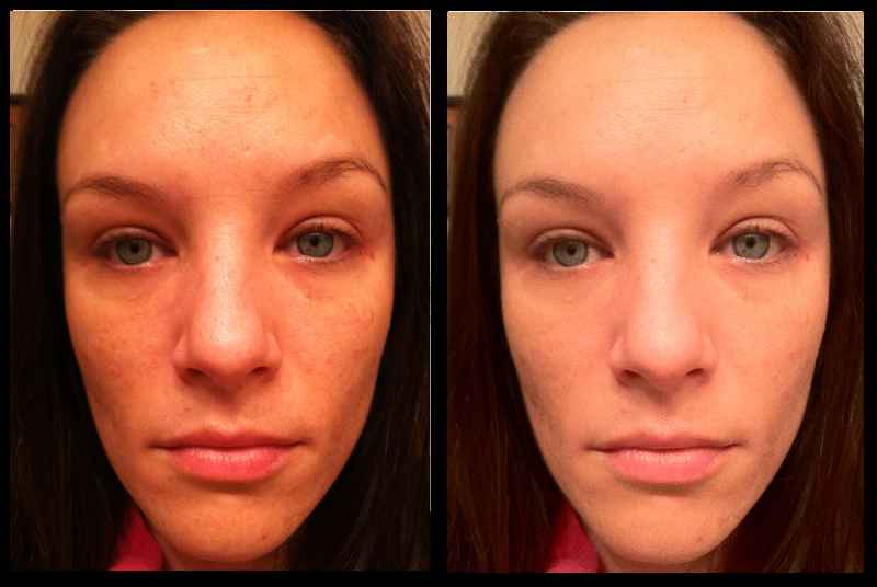 Is tretinoin 0025 effective for wrinkles