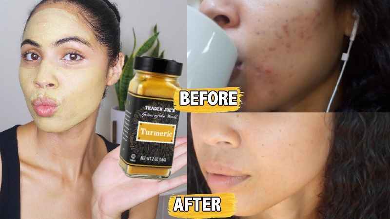 Is turmeric Good for Acne
