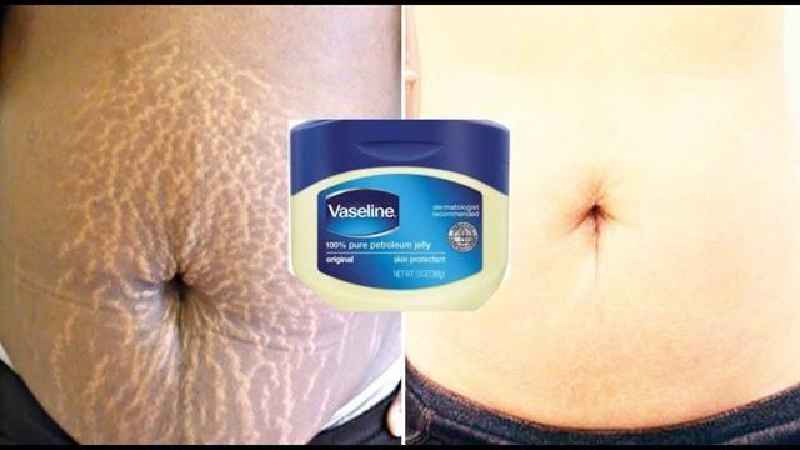 Is Vaseline good for eczema