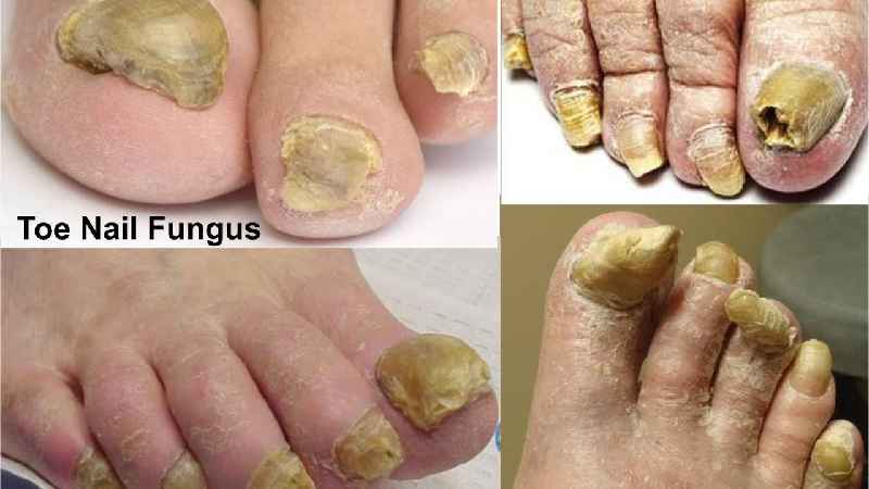 Is Vicks VapoRub good for toenail fungus