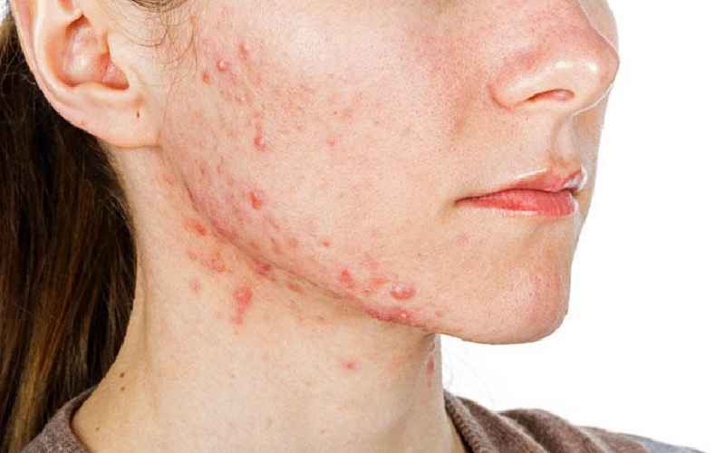 Is Vitamin C good for acne scars