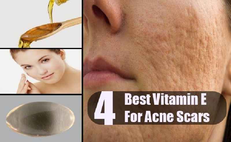 Is vitamin E good for scars