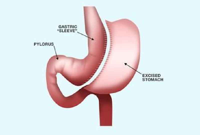 Is VSG the same as gastric sleeve