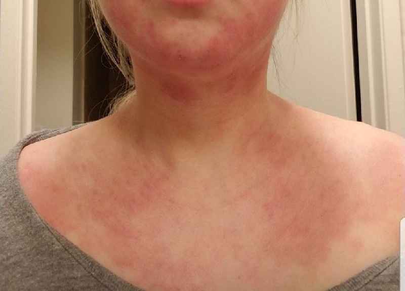 Should eczema be kept moist or dry