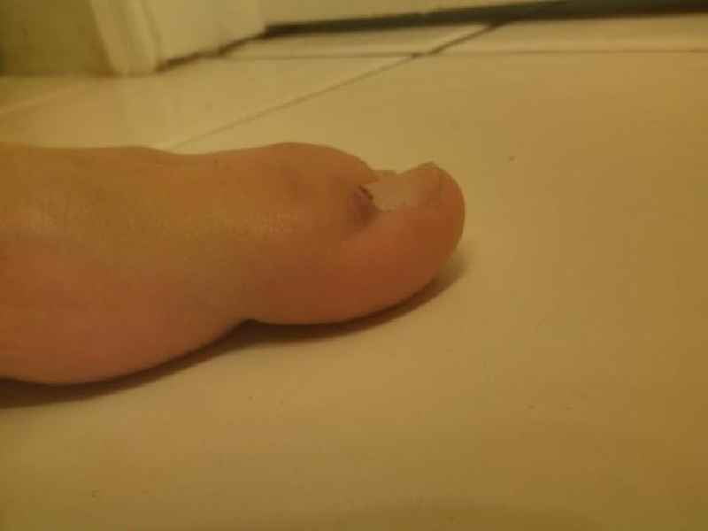 Should I go to hospital for a broken big toe