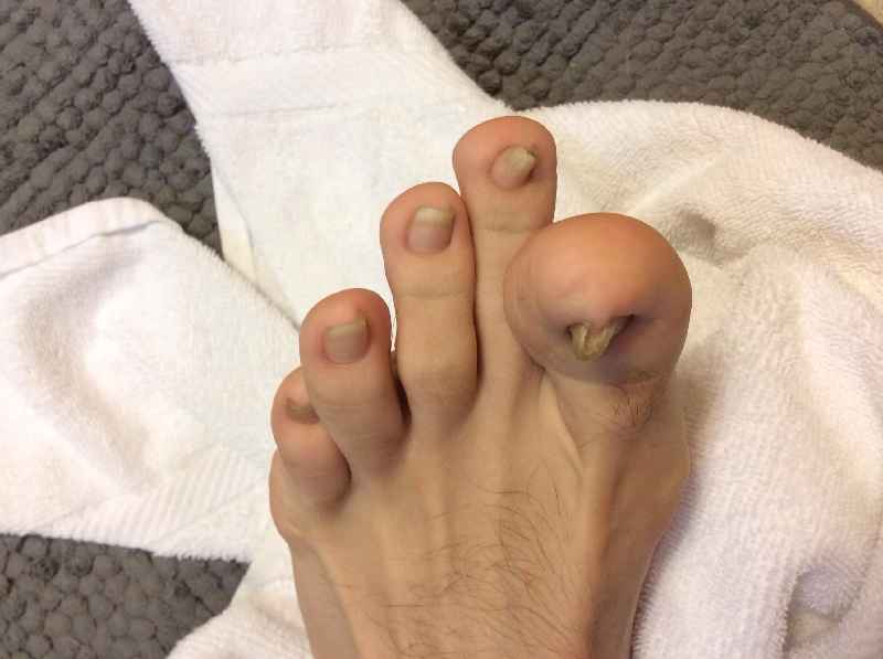 Should I have my toenail permanently removed