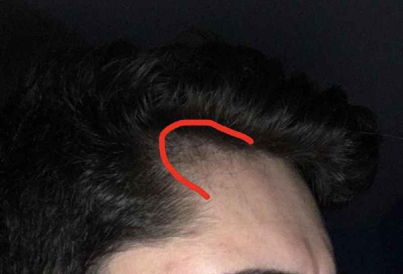 Should I see an endocrinologist for hair loss