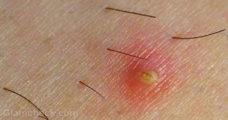 Should I shave ingrown hairs
