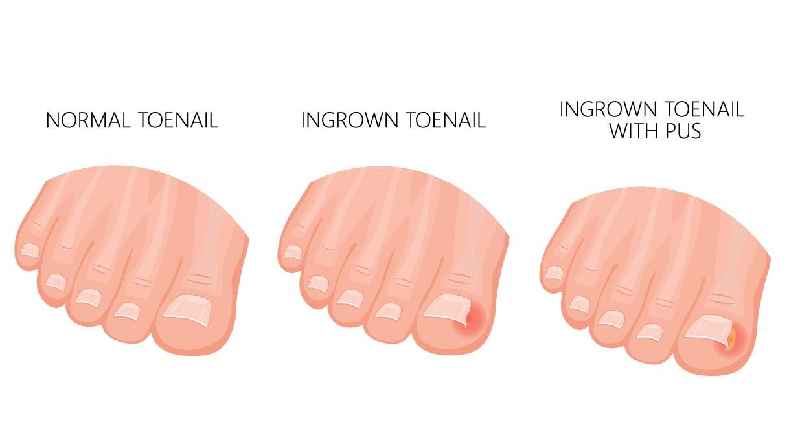 Should you pop an ingrown fingernail