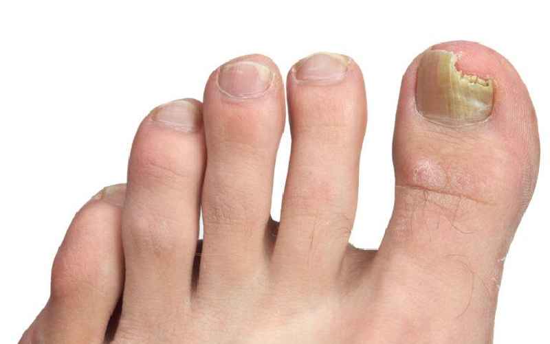 Should you remove a dead toenail